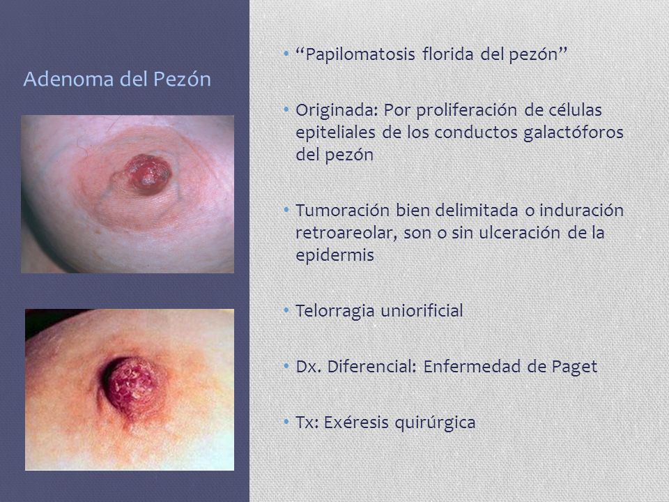 enfermedad de paget pezon sintomas
